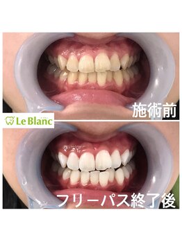 ルブラン 奈良店(Le Blanc)/完璧な白さに(^^)