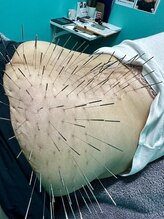 高宮レディース鍼灸整骨院/ルート鍼