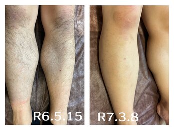 フィズ 五日市彩が丘店(FIS)/☆before/after☆五日市脱毛