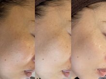 リードスラッシュ(LEAD/)/プロセルセラピーズお顔