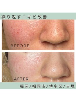 ソワ 吉塚店(soi)/ゴワつき&ニキビにお悩み!