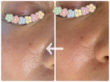 パール(PEARL)/八尾シミケア光フォト施術前後