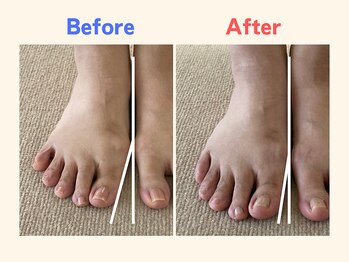 ピース/足指の曲がりが気になる40代女性