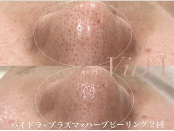 ヴィーダ 渋谷松濤(ViDA)/ハイドラ・プラズマ・ピーリング