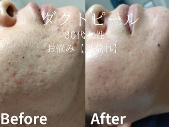 メイプル(Maple)/30代女性/お悩み→肌荒れ