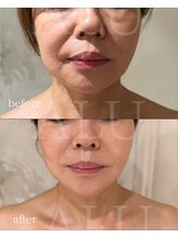 アルフォービューティー 難波店(ALU for beauty)/オンダリフト×クリスティーナ