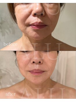 アルフォービューティー 難波店(ALU for beauty)/オンダリフト×クリスティーナ