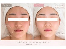 エテルナ(ETERNA)/透明感美白コース