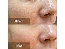 ログビューティー(LOGbeauty)の雰囲気(毛穴の開きにもアプローチ!キメが細かい透明肌。肌質改善)