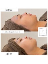 サロン ド パーフェクション(Salon de Perfection)/小顔リフト