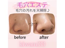 キワミ サーティスリー(kiwami33)の雰囲気(毛穴の頑固な黒ずみ角栓撃退!毛穴も引き締まりツルツル肌に◎)