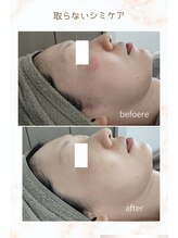 ビーユー(Be.you)/レーザー後の引かなかった赤み