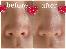 パール(PEARL)/八尾光フェイシャル施術前後