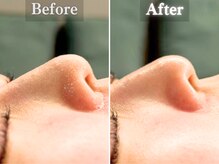 ボーンオム(Born Homme)/毛穴洗浄＋美容液導入：20代女性