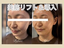 ミリュール(Millule)/1回の効果/たるみ改善