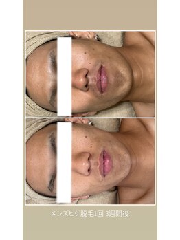ワイズルミエ(Y's Lumie)の写真/【メンズも大歓迎◎】毎朝のヒゲ剃りをラクに！最新メンズ脱毛＆セルフホワイトニングで第一印象UP★