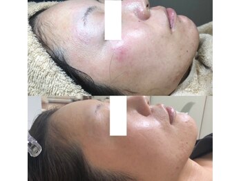 ビーダブリュー(BW...)/☆プラズマゼノデュアル施術例☆