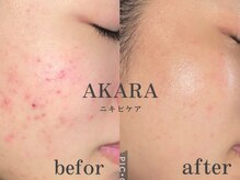 アカラ(AKALA)の雰囲気（ニキビケア多数の実績あり★独自のノウハウで約3回で改善します）