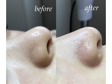 サロン ド ソワン(salon de soin)/毛穴エクストラクション