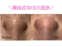 ダイヤモンド リーエンダ(Diamond leende)/韓国式3D毛穴洗浄