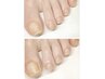 トータルフットケア(足裏角質ケア付き)