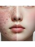 【長年の肌悩みに終止符を!!】《集中毛穴・ニキビケア》ハーブピーリング 