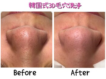 ダイヤモンド リーエンダ(Diamond leende)/韓国式3D毛穴洗浄