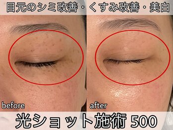 ヴィオール 名古屋栄店(VIOR)/シミ改善　光ショット施術！
