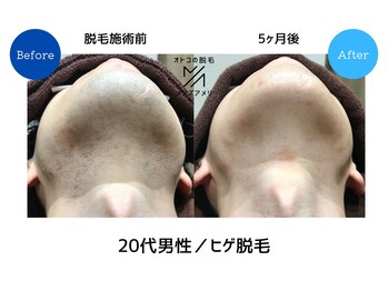 メンズアメリ/高知/メンズ脱毛/ヒゲ/全身/VIO