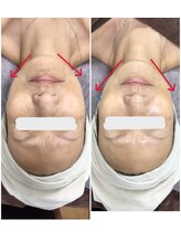 アルカンジュ(Archange)/ハイパーフェイシャル