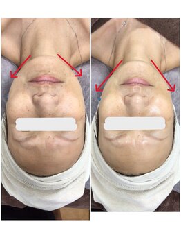 アルカンジュ(Archange)/ハイパーフェイシャル