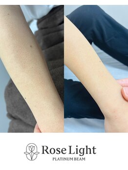 トゥインクル(Twinkle)/剃っても見える毛も・・・