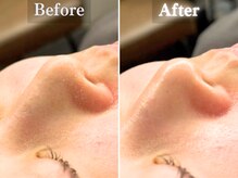 ボーンオム(Born Homme)/毛穴洗浄＋美容液導入：20代女性