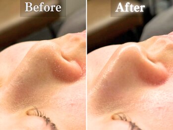 ボーンオム(Born Homme)/毛穴洗浄＋美容液導入：20代女性