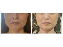 ねこのひげ/お顔の変化