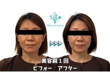 ミノリノモリ(Minorinomori)/美容鍼ビフォーアフター