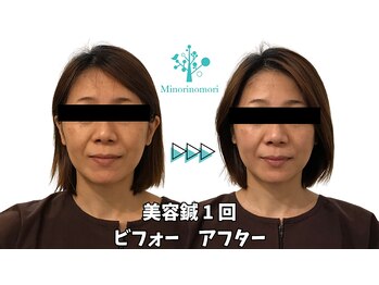 ミノリノモリ(Minorinomori)/美容鍼ビフォーアフター