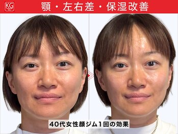 顔ジム 麻布店/40代女性顔ジム1回の効果