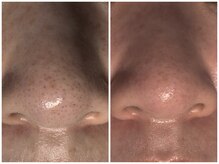 サラグランデ(Sara Grande)/メンズ◎毛穴エクストラクション