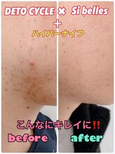 ルミネ(Lumine)/肌荒れにも効果出てます！