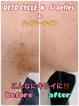 ルミネ(Lumine)/肌荒れにも効果出てます！