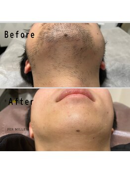 パーミル(per mille‰)/Before/After