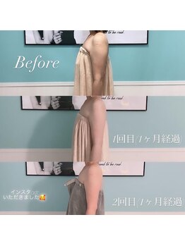 ビーナスアイスブルー(Venus ICE BLUE)/二の腕の脂肪冷却