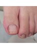 足の親指の巻爪が痛み緩和！Ｂ／Ｓブレイス巻爪改善1本※親指のみ￥3600