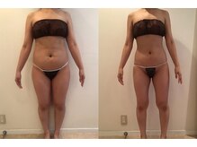 ビューティーマックス(Beauty Max)/痩身　before→after 4ヶ月後