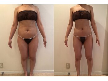 ビューティーマックス(Beauty Max)/痩身　before→after 4ヶ月後