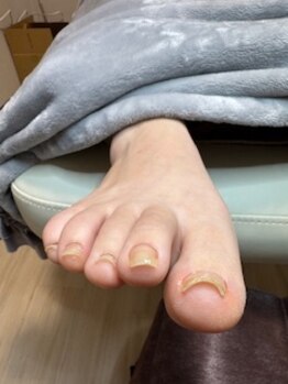 しあん 京都/巻き爪・反り爪