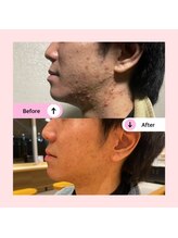 アネラ(ANELA)/ニキビケア