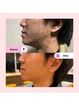 アネラ(ANELA)/ニキビケア