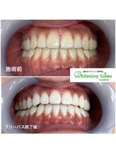 ホワイトニングサロン 名古屋駅店/【ホワイトニング施術例】